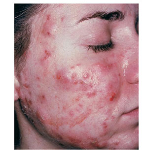 cystic-acne-face